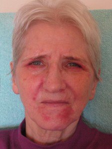 Hautmilben bei Rosacea